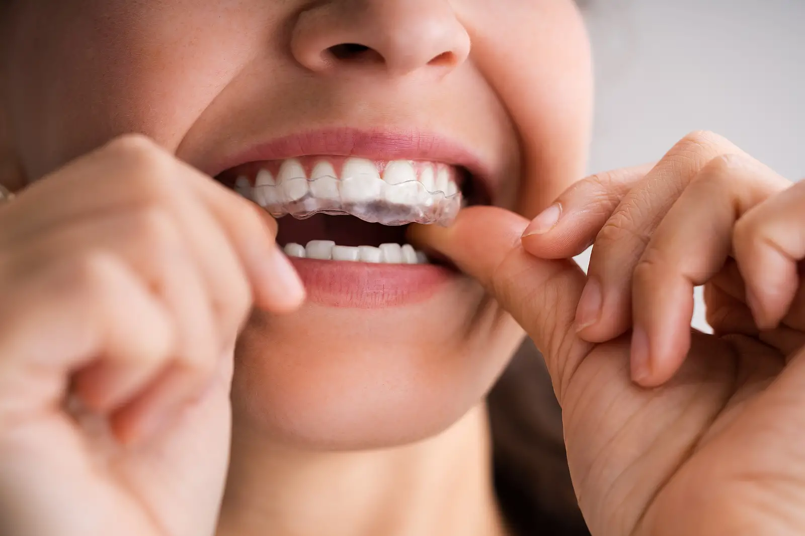 Common Dental Problems That Invisalign Can Fix